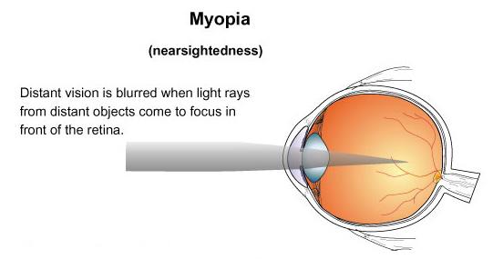 retina miopia)